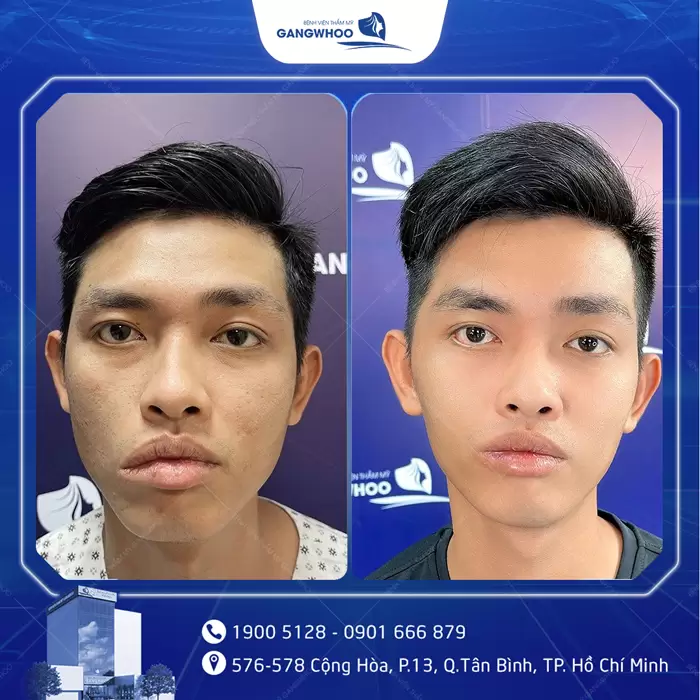 Điều Trị Liệt Mặt Nội Soi 4K - Lấy Lại Nụ Cười Trên Gương Mặt 17 hinh anh dieu tri liet mat 16