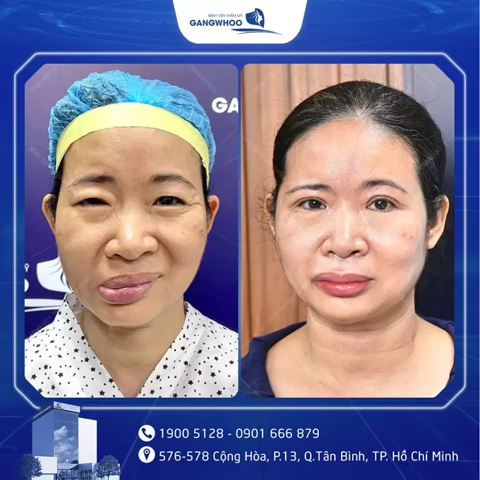 Điều Trị Liệt Mặt Nội Soi 4K - Lấy Lại Nụ Cười Trên Gương Mặt 18 hinh anh dieu tri liet mat 17