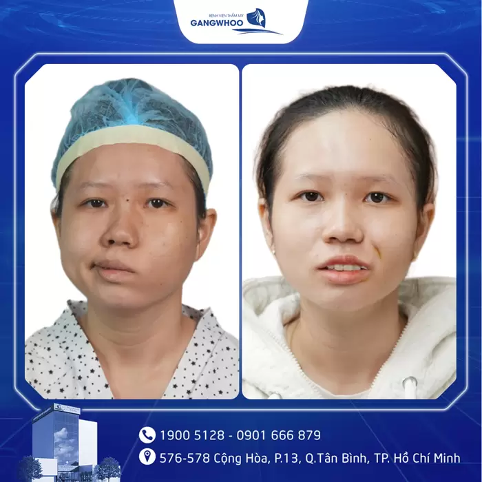 Điều Trị Liệt Mặt Nội Soi 4K - Lấy Lại Nụ Cười Trên Gương Mặt 10 hinh anh dieu tri liet mat 18