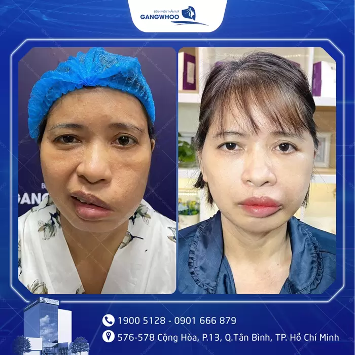 Điều Trị Liệt Mặt Nội Soi 4K - Lấy Lại Nụ Cười Trên Gương Mặt 12 hinh anh dieu tri liet mat 2