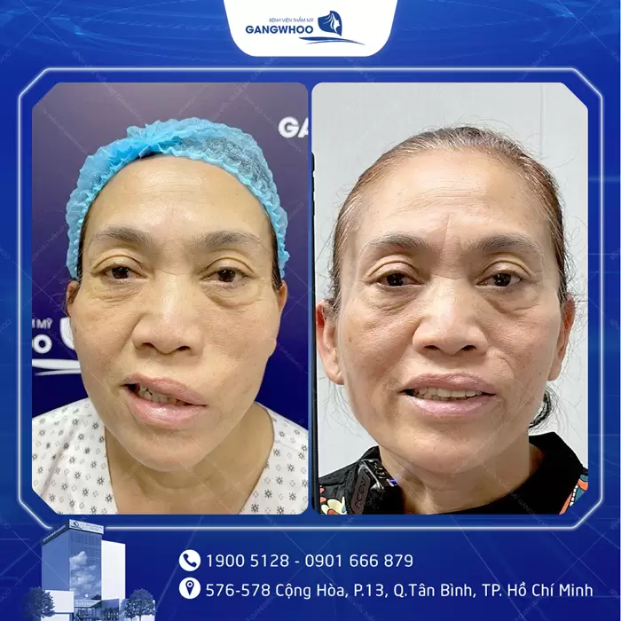 Điều Trị Liệt Mặt Nội Soi 4K - Lấy Lại Nụ Cười Trên Gương Mặt 14 hinh anh dieu tri liet mat 4