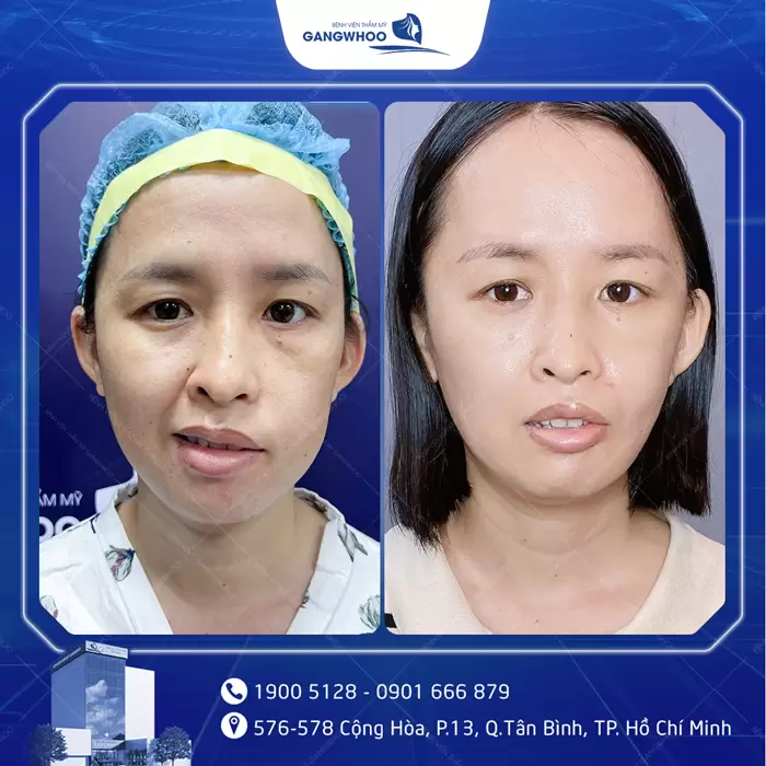 Điều Trị Liệt Mặt Nội Soi 4K - Lấy Lại Nụ Cười Trên Gương Mặt 15 hinh anh dieu tri liet mat 5