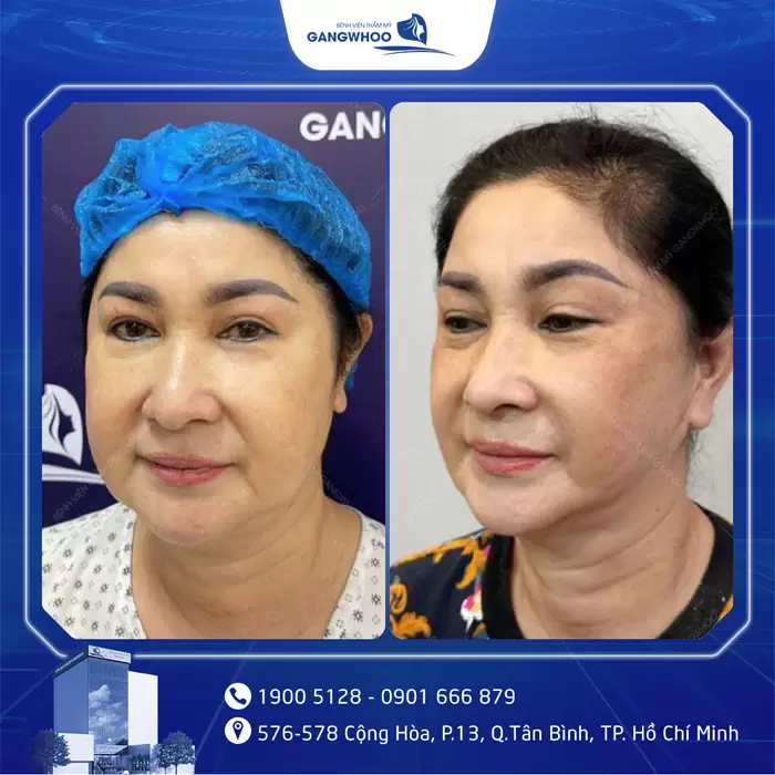 hinh anh hut mo ma 3