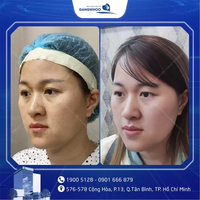 hinh anh hut mo ma 4