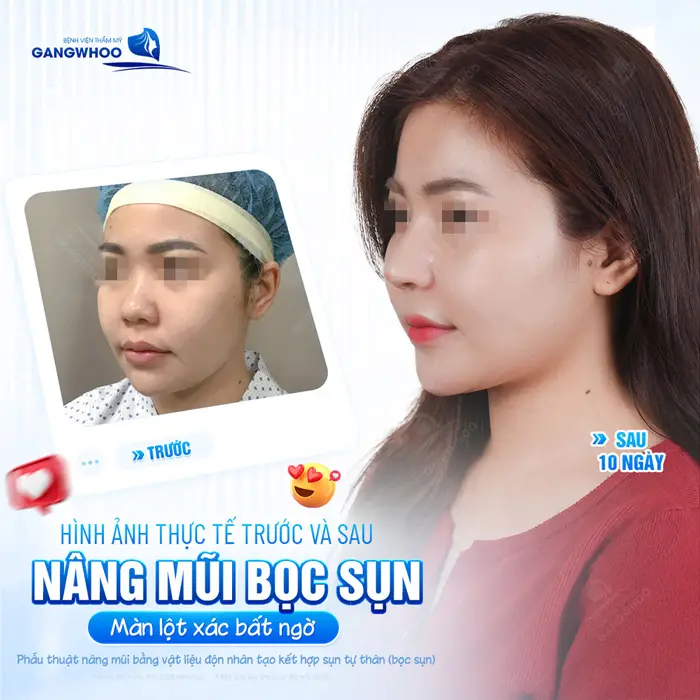 Hình ảnh thực tế trước và sau nang mũi bọc sụn màn lột xác bất ngờ chỉ sau 10 ngày nhan sắc đã thăng hạng đáng kể
