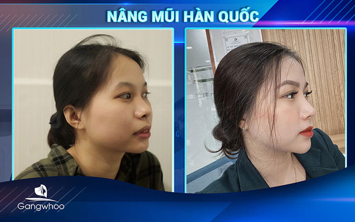 Images of our customers before & after Korean rhinoplasty