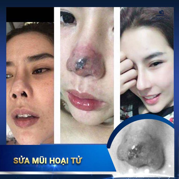 Images of our customers before & after nose revision at Gangwhoo Cosmetic Hospital