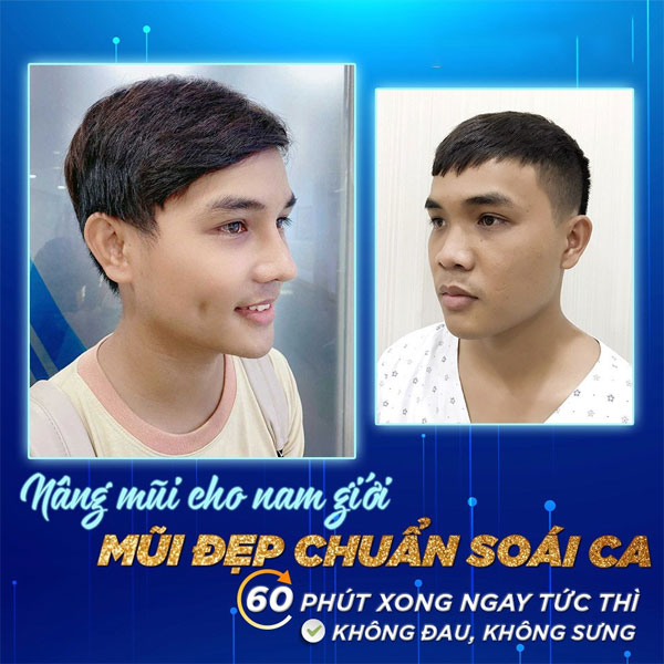 KH nâng mũi thì tức khắc thành “hot boy”