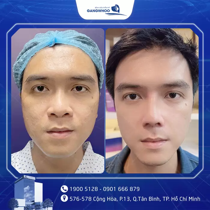 បង្រួមស្លាបច្រមុះ កែច្រមុះធំ ទូលាយ ឱ្យក្លាយជារាងស្លីម 7 hinh anh thu gon canh mui 1