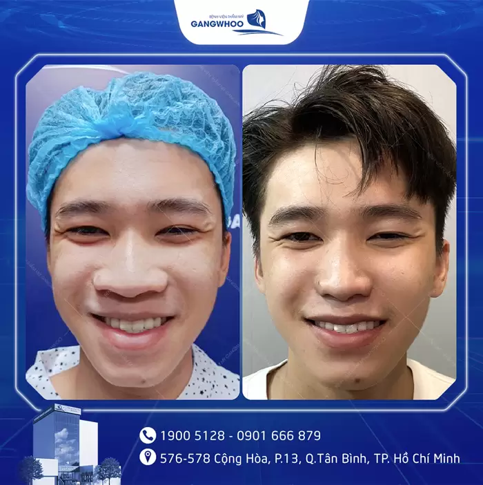 បង្រួមស្លាបច្រមុះ កែច្រមុះធំ ទូលាយ ឱ្យក្លាយជារាងស្លីម 8 hinh anh thu gon canh mui 2