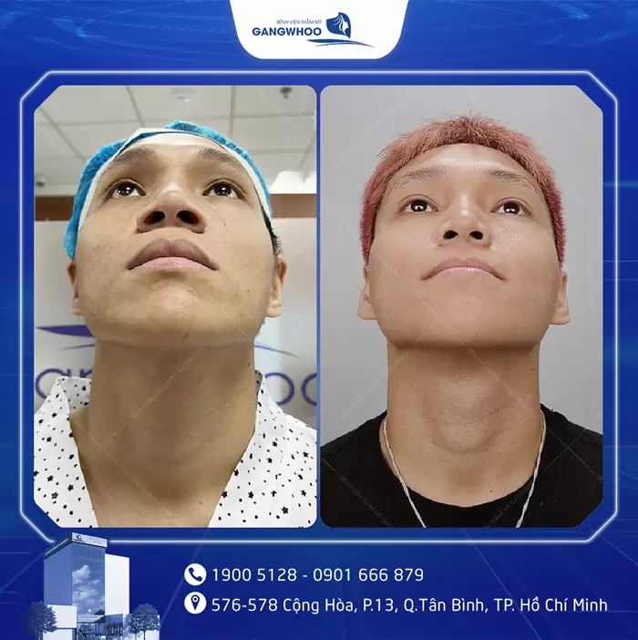 បង្រួមស្លាបច្រមុះ កែច្រមុះធំ ទូលាយ ឱ្យក្លាយជារាងស្លីម 9 hinh anh thu gon canh mui 3