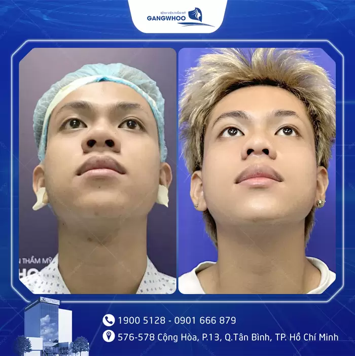 បង្រួមស្លាបច្រមុះ កែច្រមុះធំ ទូលាយ ឱ្យក្លាយជារាងស្លីម 10 hinh anh thu gon canh mui 4