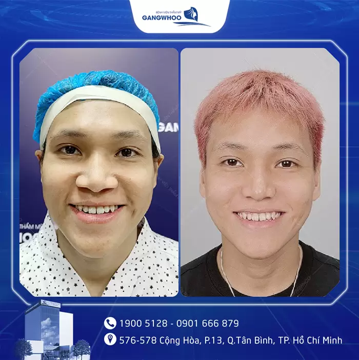 បង្រួមស្លាបច្រមុះ កែច្រមុះធំ ទូលាយ ឱ្យក្លាយជារាងស្លីម 11 hinh anh thu gon canh mui 5