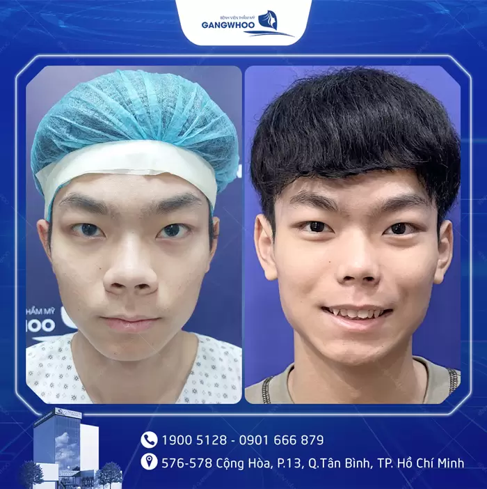 បង្រួមស្លាបច្រមុះ កែច្រមុះធំ ទូលាយ ឱ្យក្លាយជារាងស្លីម 12 hinh anh thu gon canh mui 6