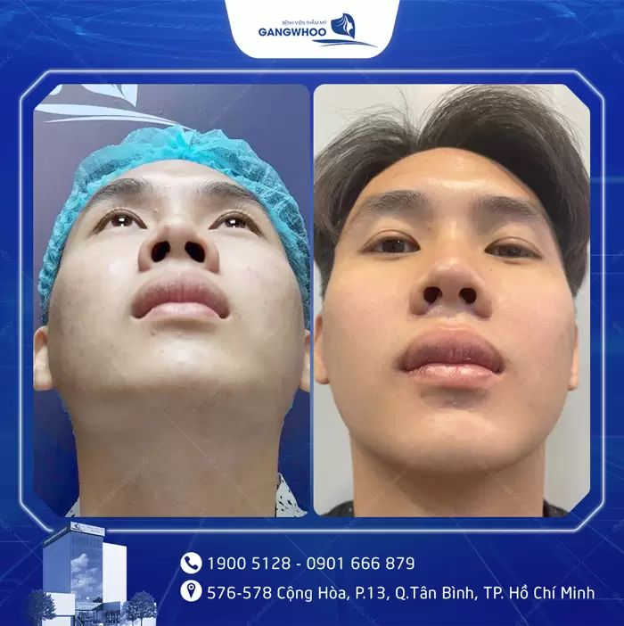 បង្រួមស្លាបច្រមុះ កែច្រមុះធំ ទូលាយ ឱ្យក្លាយជារាងស្លីម 6 hinh anh thu gon canh mui 8