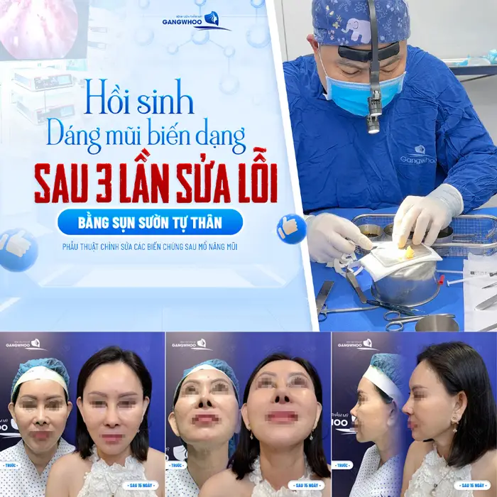 Hồi sinh dáng mũi biến dạng sau 3 lần sửa lỗi bằng sụn sườn tự thân 