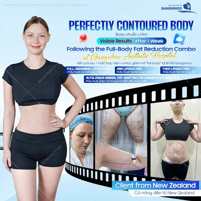 Khách hàng đến từ New Zealand thực hiện hút mỡ toàn thân
