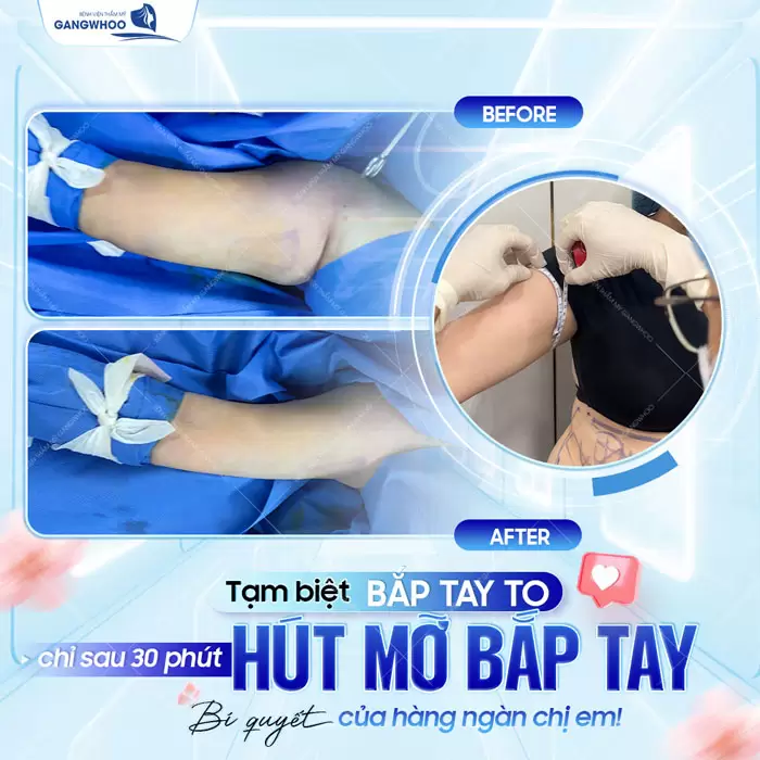 Hút Mỡ Cánh Tay Giúp Lấy Lại Đôi Tay Thon Gọn Nhanh Chóng 29 Tạm biệt bắp tay to chỉ sau 30 phút hút mỡ bắp tay là lựa chọn của hàng ngàn chị em phụ nữ