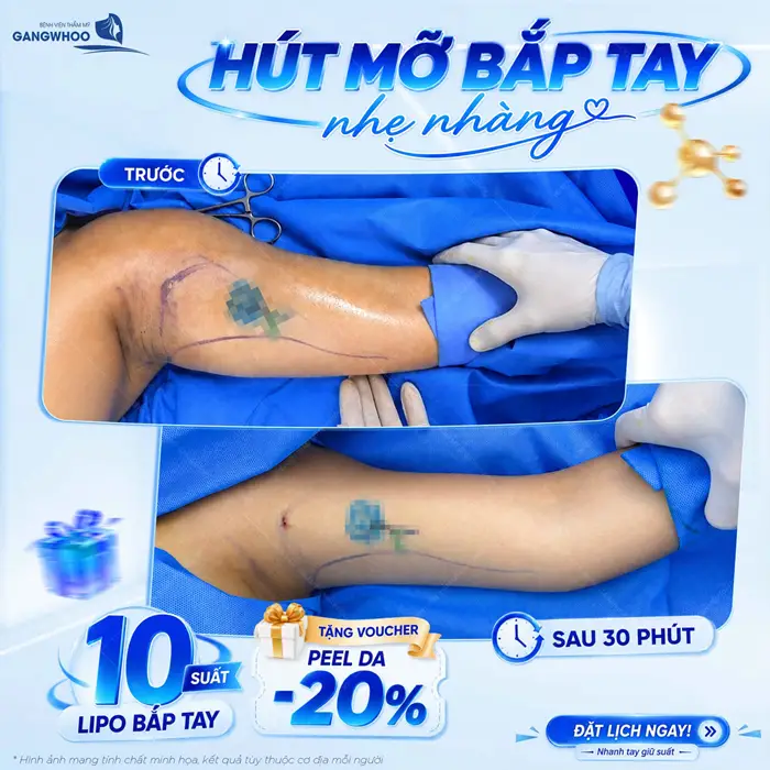 Phẫu Thuật Hút Mỡ Vùng Cánh Tay Giúp Đôi Tay Thon Gọn Nhanh Chóng 10 Hút mỡ bắp tay nhẹ nhàng kết quả thay đổi rõ rệt sau 30 phút đã hoàn toàn khác biệt