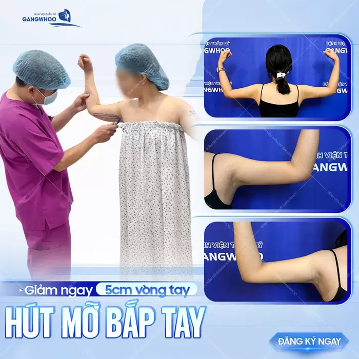 Hút Mỡ Cánh Tay Giúp Lấy Lại Đôi Tay Thon Gọn Nhanh Chóng 7 Hút mỡ bắp tay giảm ngay 5cm vòng tay hiệu quả, nhẹ nhàng và an toàn