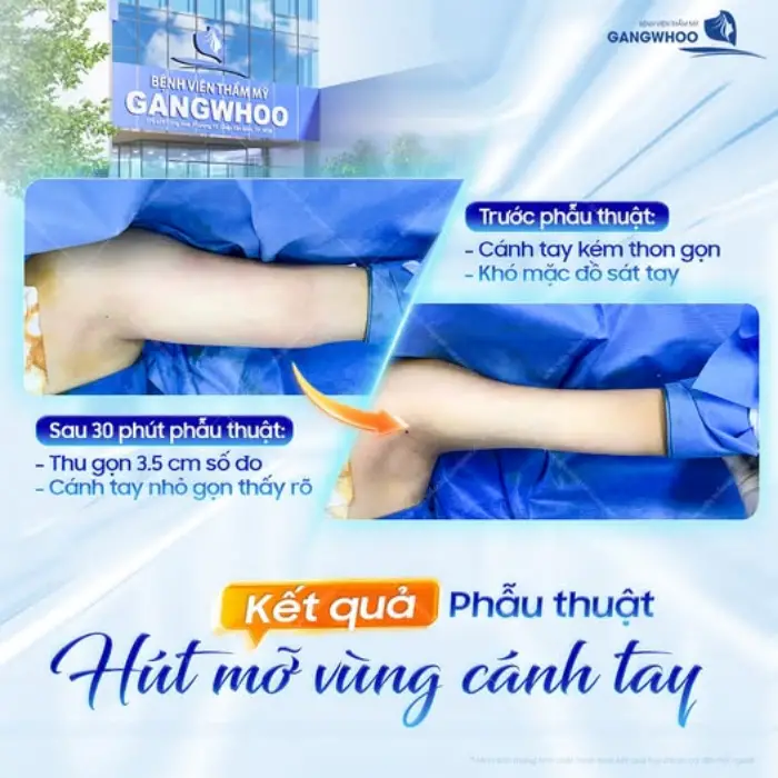 Hút mỡ cánh tay thu gọn 3.5cm số đo, bắp tay thon gọn chỉ sau 30 phút