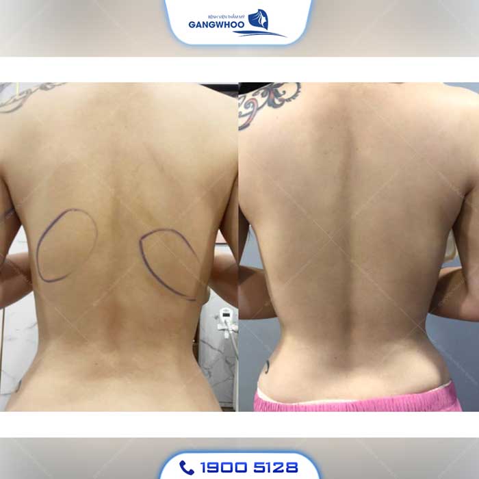 Phẫu Thuật Hút Mỡ Vùng Lưng (Lipo Ultrasound) 100% Khách Hàng Hài Lòng 9 hut mo lung 1 1