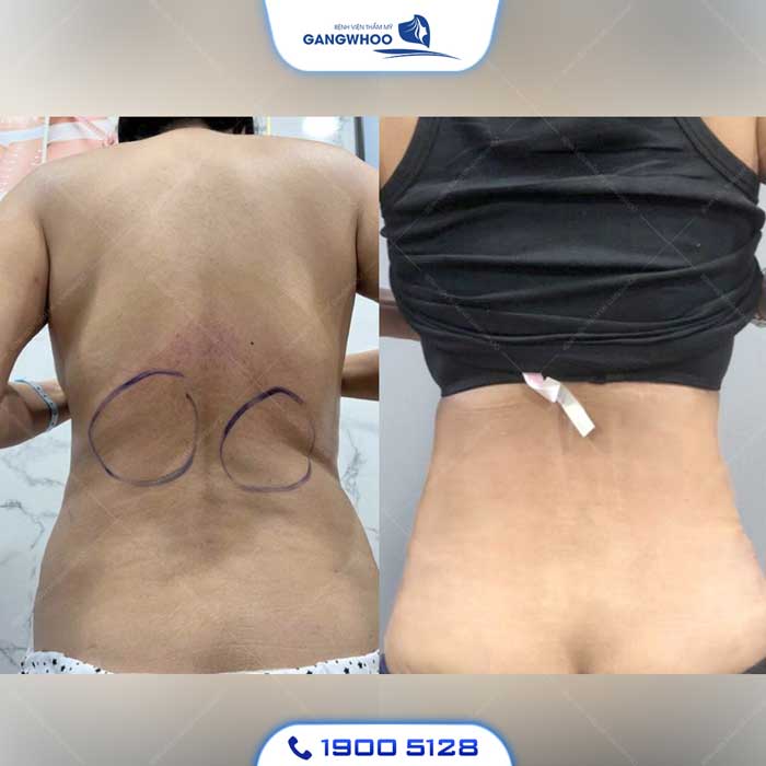 Phẫu Thuật Hút Mỡ Vùng Lưng (Lipo Ultrasound) 100% Khách Hàng Hài Lòng 12 hut mo lung 4