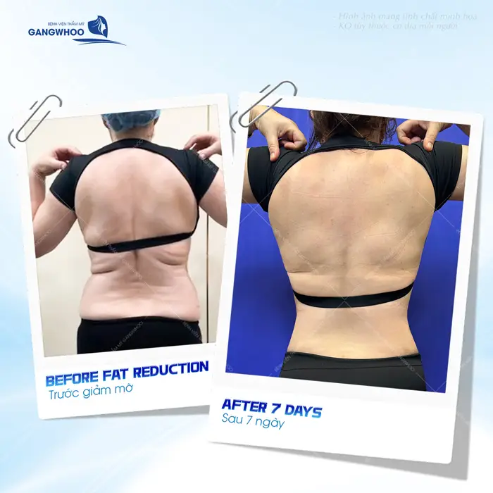 Phẫu Thuật Hút Mỡ Vùng Lưng (Lipo Ultrasound) 100% Khách Hàng Hài Lòng 6 Sau 7 ngày giảm mỡ lưng tự tin hơn với đường cong quyến rũ nuột nà