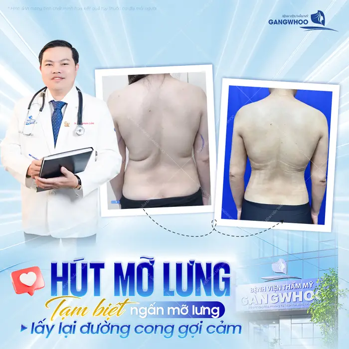 Phẫu Thuật Hút Mỡ Vùng Lưng (Lipo Ultrasound) 100% Khách Hàng Hài Lòng 3 Phẫu Thuật Hút Mỡ Vùng Lưng tạm biệt ngấn mỡ lưng lấy lại đường con gợi cảm và cuốn hút