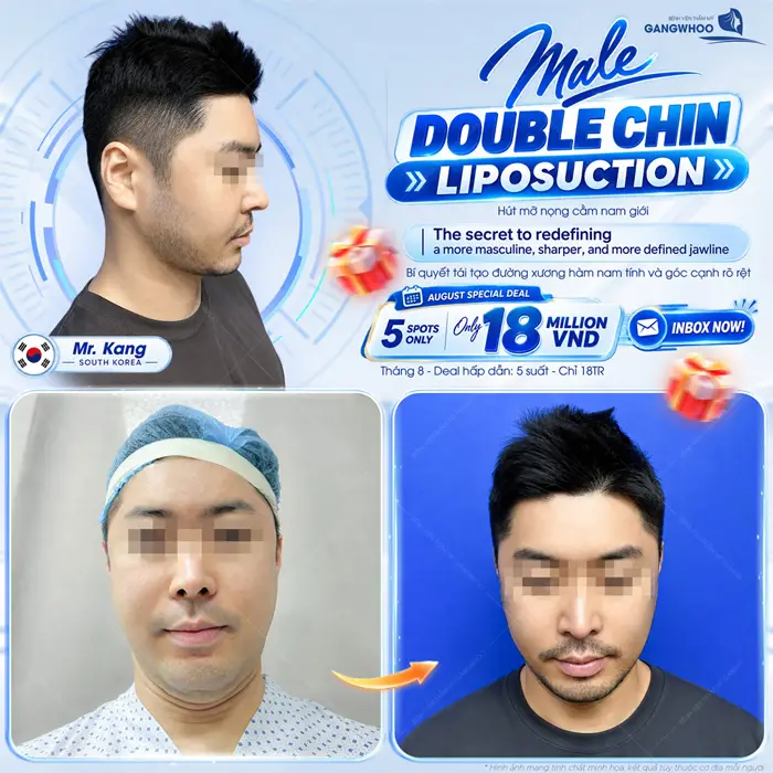 Hút mỡ nọng cằm cho nam giới bí quyết giúp xương hàm đẹp thon gọn và mềm mại hài hòa
