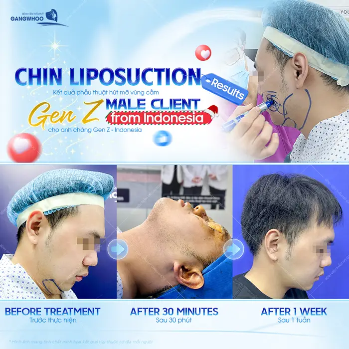 Hút Mỡ Cằm Thổi Bay 99% Nọng Mỡ Tích Cằm Hiệu Quả 16 Phẫu thuật hút mỡ nọng cằm sau 1 tuần đã ổn định và vào form đẹp thấy rõ