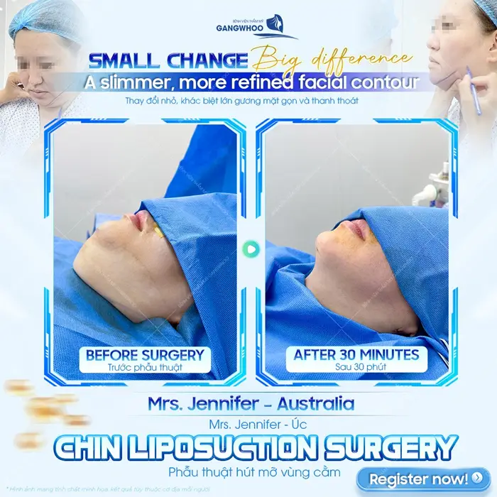 Phẫu thuật hút mỡ vùng cằm cải thiện nọng cằm thon gọn hiệu quả sau 1 ngày thực hiện