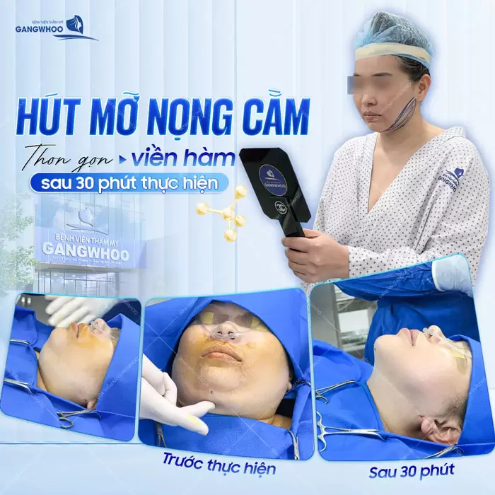 Hút Mỡ Toàn Thân An Toàn, Không Biến Chứng, Hiệu Quả Cao 3 Hút mỡ nọng cằm thon gọn viềm hàm hiệu quả sau 30 phút thực hiện