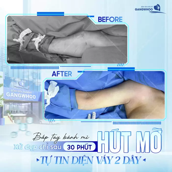 Hút Mỡ Cánh Tay Giúp Lấy Lại Đôi Tay Thon Gọn Nhanh Chóng 28 Khách hàng thực hiện hút mỡ bắp tay sau 30 phút