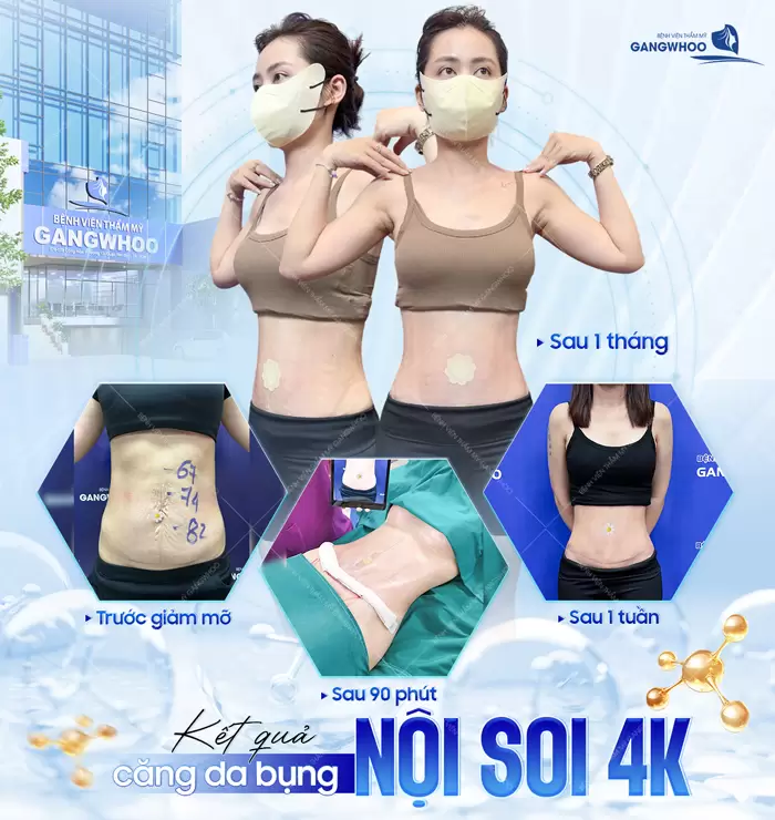 Căng Da Bụng Là Gì? Trường Hợp Nào Nên Và Không Nên Thực Hiện 22 Căng Da Bụng Là Gì? Trường Hợp Nào Nên Và Không Nên Thực Hiện