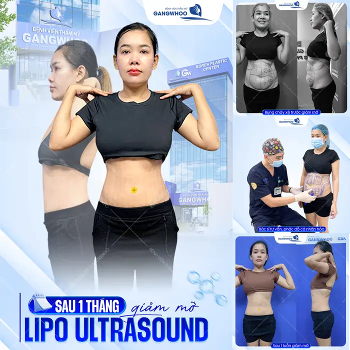 Lipo Ultrasound: Công Nghệ Hút Mỡ Được Nhiều Khách Quốc Tế Lựa Chọn 38 ket qua giam mo lipo ultrasound sau 1 thang thuc hien