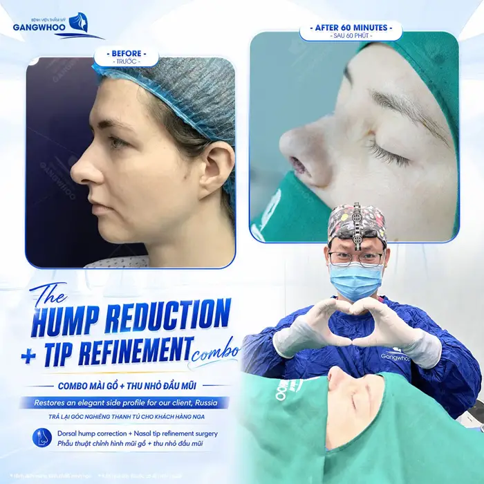 Mài gồ kết hợp thu nhỏ đầu mũi cải thiện khuyết điểm phần sống mũi hiệu quả và an toàn