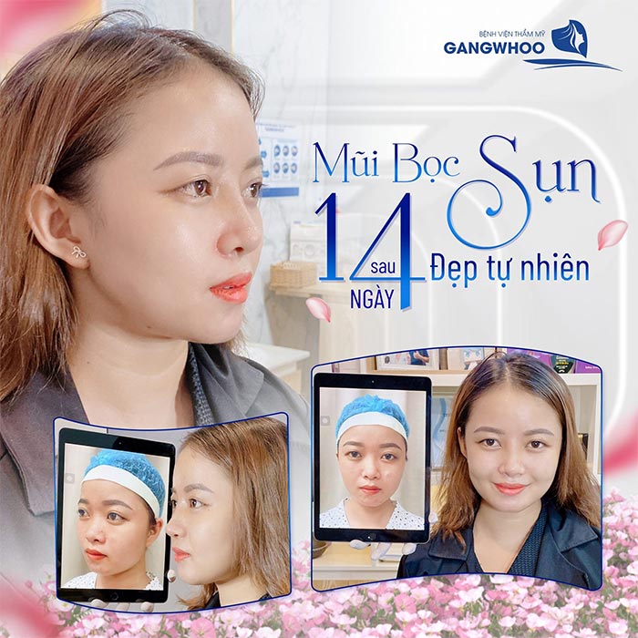 Nâng Mũi Nên Bọc Sụn Tai Hay Sụn Megaderm Tốt Hơn? 9 Nâng Mũi Nên Bọc Sụn Tai Hay Sụn Megaderm Tốt Hơn?