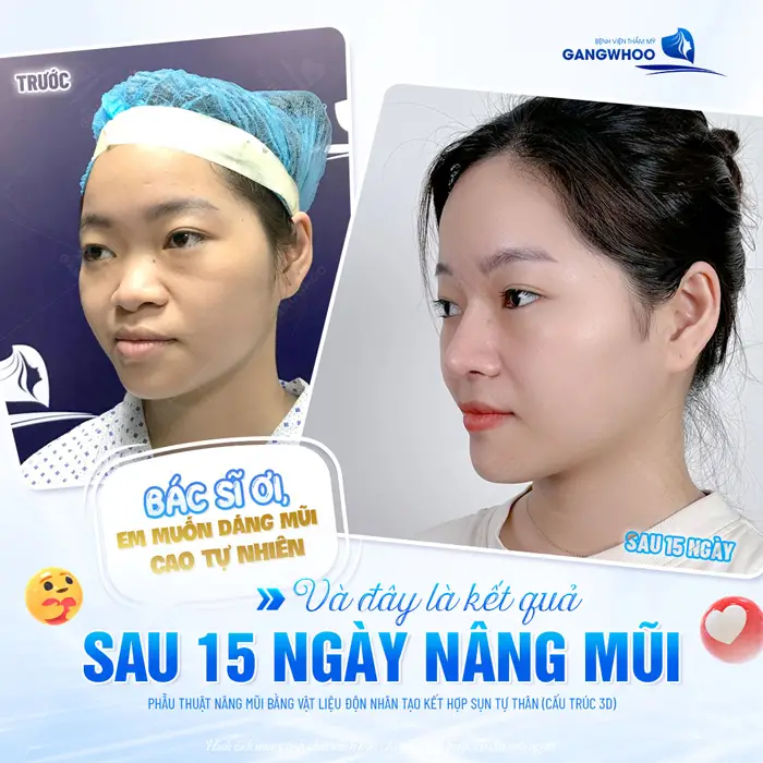Sau 15 ngày nâng mũi kết quả đã đẹp siêu tự nhiên và chân thực 