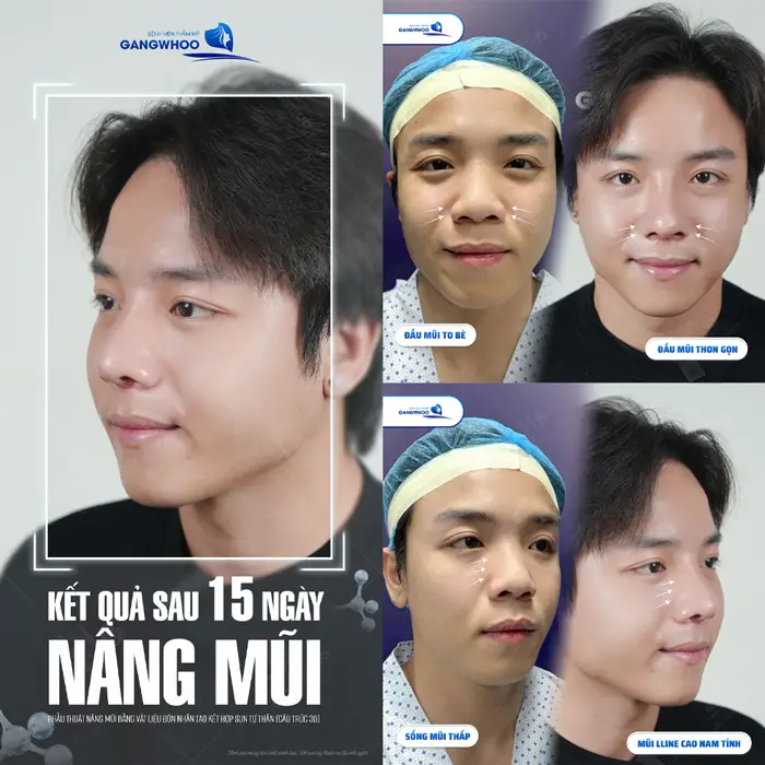 Kết quả sau 15 ngày nâng mũi từ mũi thấp bè đến cao đẹp thon gọn 