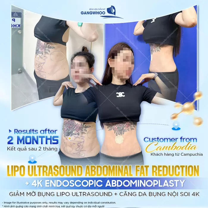 Căng Da Bụng Là Gì? Trường Hợp Nào Nên Và Không Nên Thực Hiện 4 Giảm mỡ bụng Lipo Ultrasound và căng da bụng nội soi 4K kết quả thay đổi sau 2 tháng thực hiện