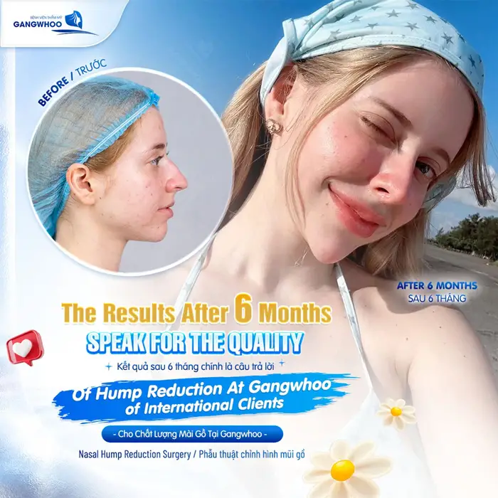 Kết quả sau 6 tháng sau mài gồ xương mũi nhan sắc thêm thăng hạng và đầy rạng rỡ