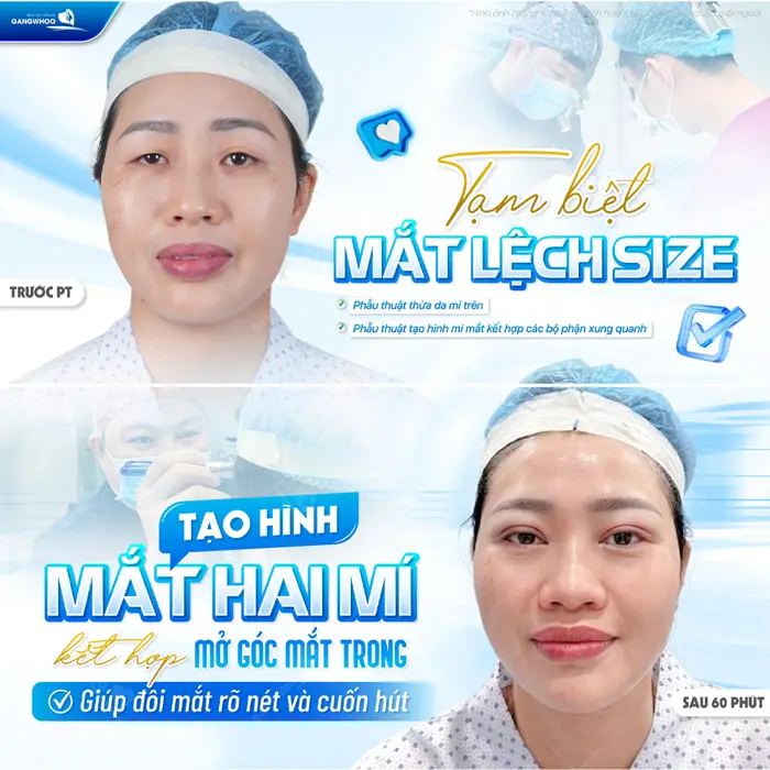 Tạo hình mắt 2 mí kết hợp mở góc mắt trong giúp đôi mắt đẹp rõ nét và ngày càng cuốn hút