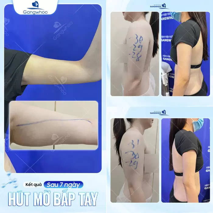 Hút Mỡ Cánh Tay Giúp Lấy Lại Đôi Tay Thon Gọn Nhanh Chóng 3 Kết quả sau 7 ngày giảm mỡ bắp tay chị khách hàng nay đã tự tin hơn với phiên bản mới của chính mình