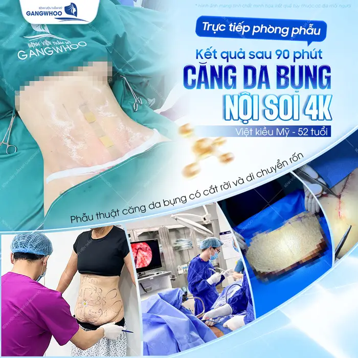 Kết quả sau 90 phút phẫu thuật căng da bụng nội soi 4K của Việt Kiều Mỹ 52 tuổi