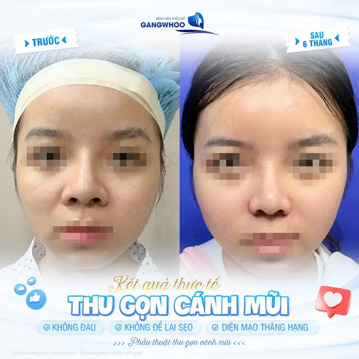 Phẫu Thuật Thu Gọn Cánh Mũi Khắc Phục Mũi To Bè Trở Nên Thon Gọn 17 Kết quả thực tế sau thu gọn cánh mũi tại BVTM Gangwhoo không đau, không để lại sẹo và diện mạo đẹp thăng hạng