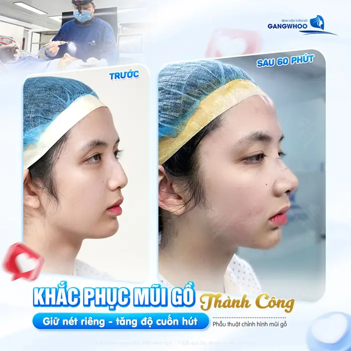 Khắc phục mũi gồ thành công giữ nét riêng tăng độ cuốn hút cho diện mạo khuôn mặt