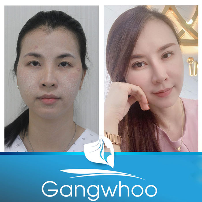 Images of our customers before & after Korean blepharoplasty