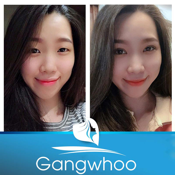 Hình ảnh khách hàng trước và sau bấm mí Hàn Quốc
