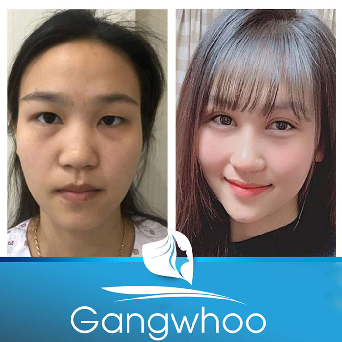 Images of our customers before & after Korean blepharoplasty